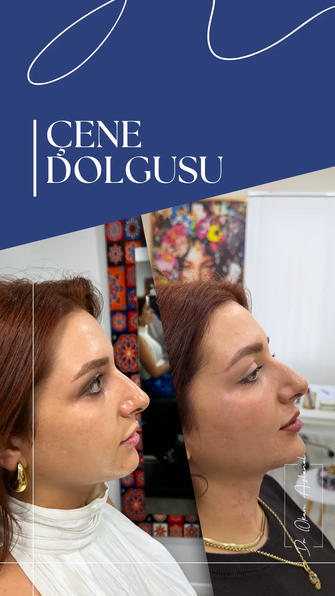 ÇENE DOLGUSU